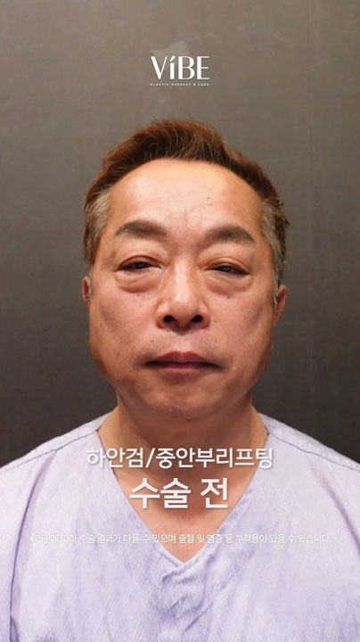 눈밑 불룩한 지방 고민 해결! 하안검 + 중안부리프팅 1개월 후