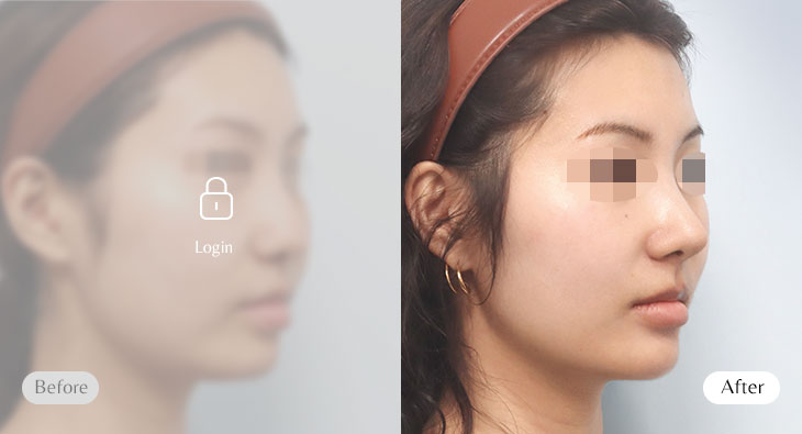 무보형물 자가늑코성형 전후사진