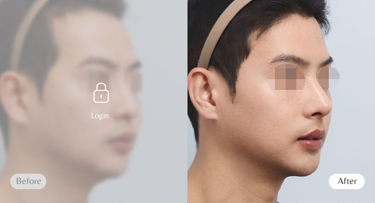 무보형물 코성형 전후사진