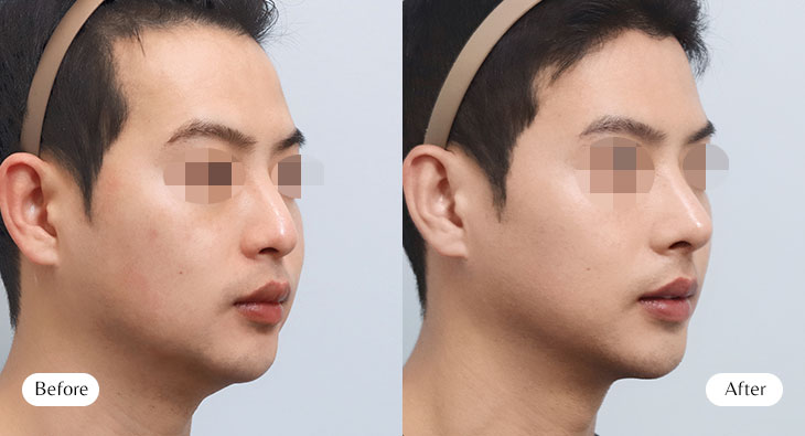 무보형물 코성형 전후사진