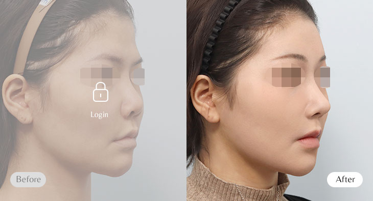 이마거상+쌍꺼풀+코재수술 전후사진