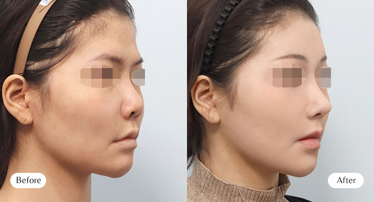 이마거상+쌍꺼풀+코재수술 전후사진