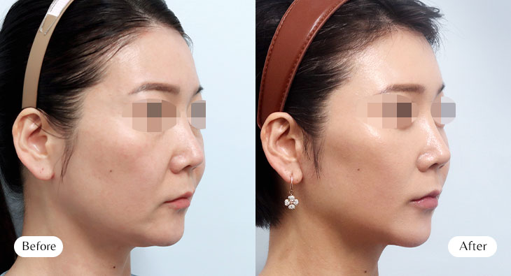 이마안면거상+상하안검 전후사진