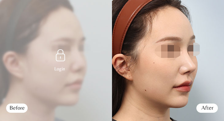 이마거상+코재수술 전후사진