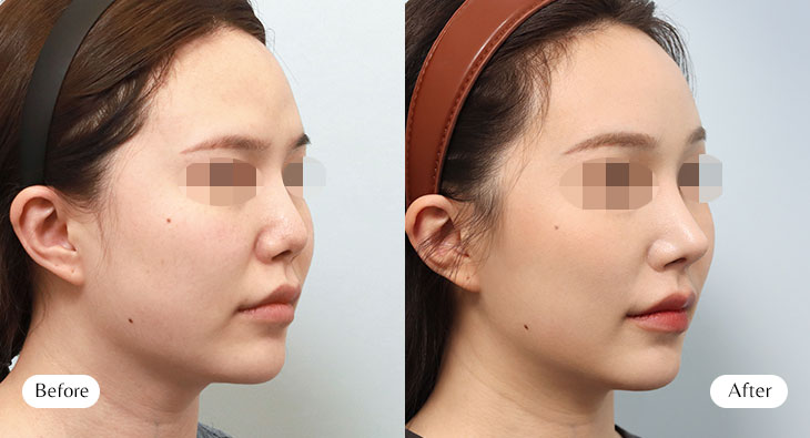 이마거상+코재수술 전후사진