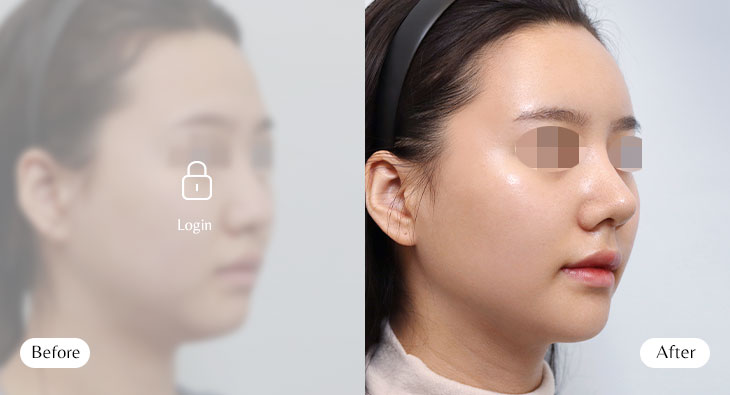 코+얼굴지방흡입 전후사진