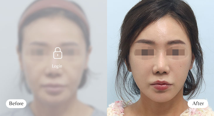 이마+안면+목거상 전후사진