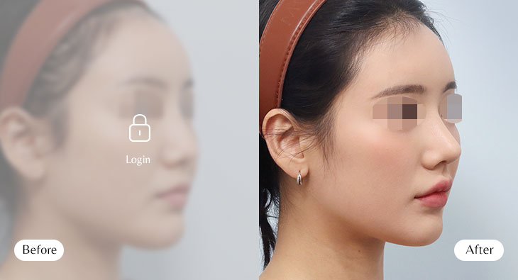 무보형물코성형 전후사진