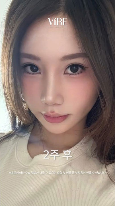 코재수술 2주 변화과정 동영상으로 보여드립니다📹｜코성형, 긴코, 복코