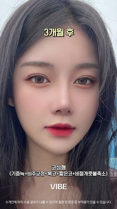 코성형 + 기증늑 + 비주교정 + 복코 + 짧은코 + 비절개콧볼축소