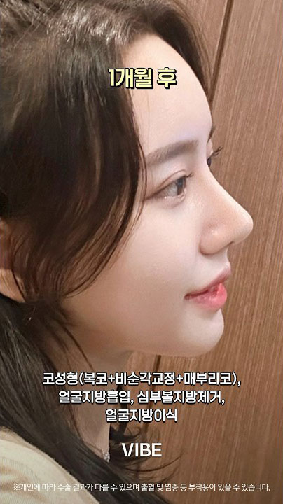 코성형(복코+비순각교정+매부리코), 얼굴지방흡입, 심부볼지방제거, 얼굴지방이식
