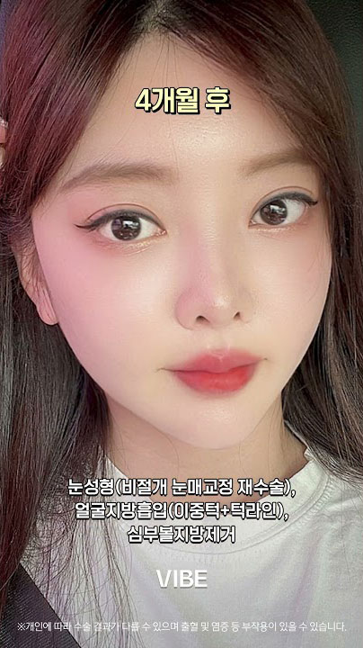 눈성형(비절개 눈매교정 재수술), 얼굴지방흡입(이중턱+턱라인), 심부볼지방제거