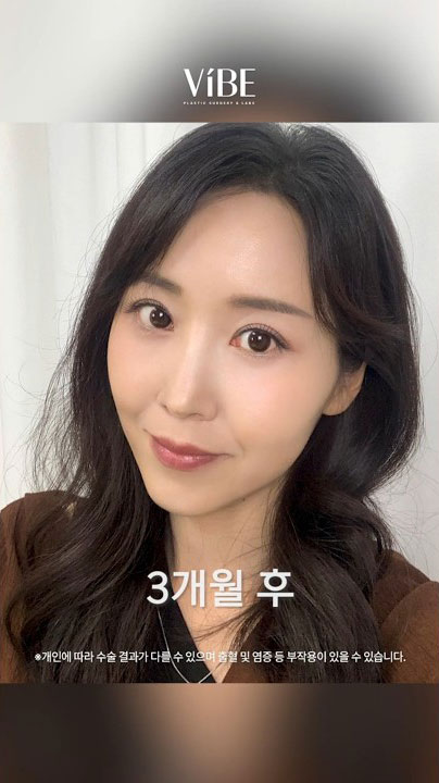 불룩한 눈밑 다크서클! 하안검 + 치크리프팅 주차별 변화