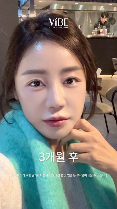 안티에이징 변화과정 총정리(셀카포함).zip 📁 ｜안면거상 & 미니스마스거상