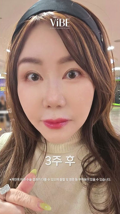 VIBE 안면거상 재수술📸 칼귀 수술 찾고있다면 꼭 보세요!