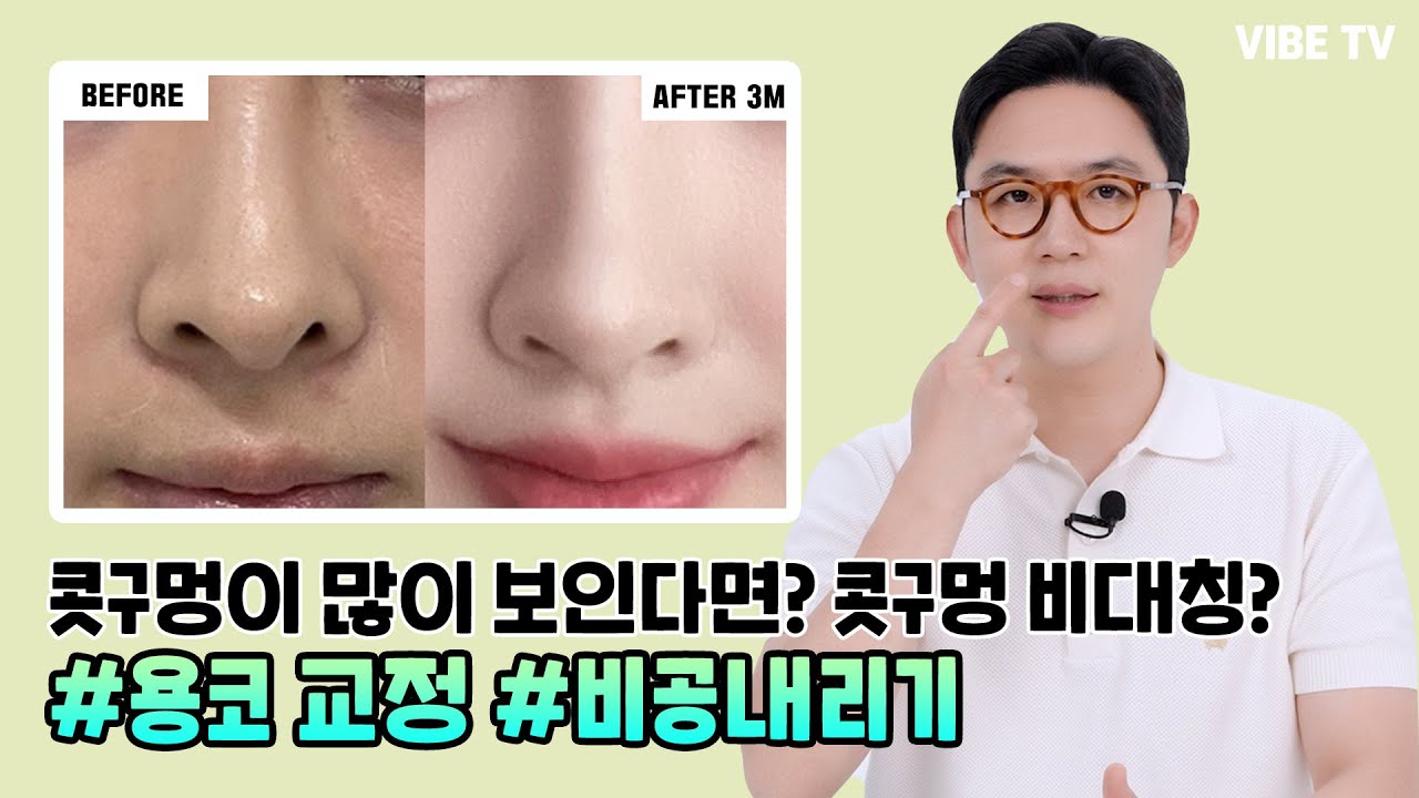 콧구멍이 많이 보여서 콤플렉스라면?? 콧구멍 비대칭, 용코, 찝힌코는 비공내리기 수술로 교정 가능!