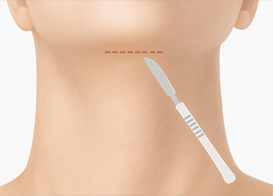 이중턱 근육묶기 수술 방법 step 01 최소 절개 후 박리