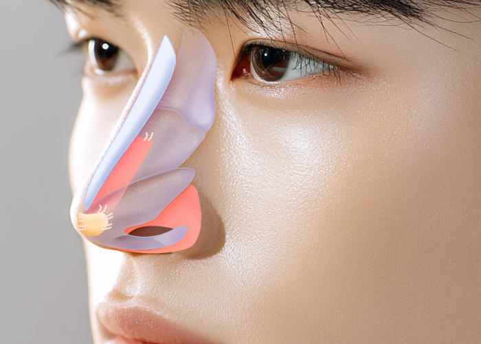 남자코성형 수술 방법 case 02 자가늑코성형