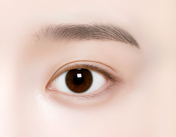 하안검 수술 방법 step 04 동안 눈매 완성