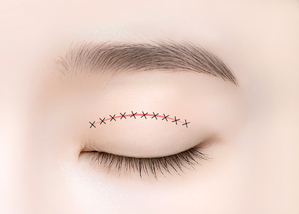 상안검 수술 방법 step 03 지방 및 피부 제거