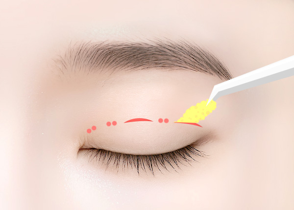 부분절개 쌍꺼풀 수술 방법 step 03 불필요한 조직 제거