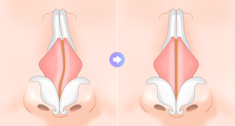 휜코 수술 방법 case 01 휘어진 정도가 가벼운 경우