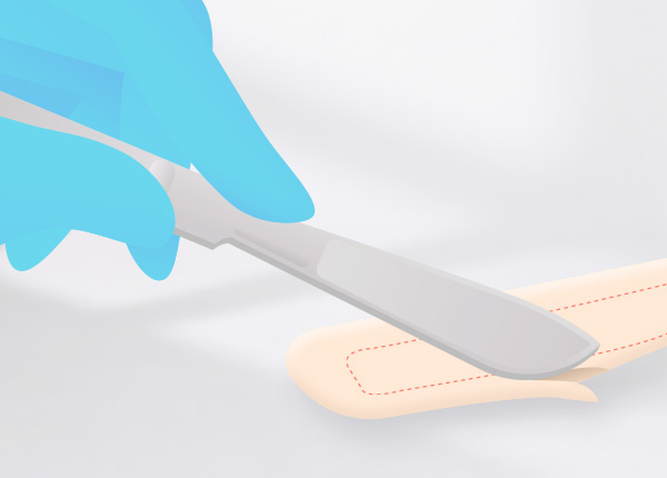 자가늑코성형 수술 방법 3. 코에 맞춘 연골 디자인