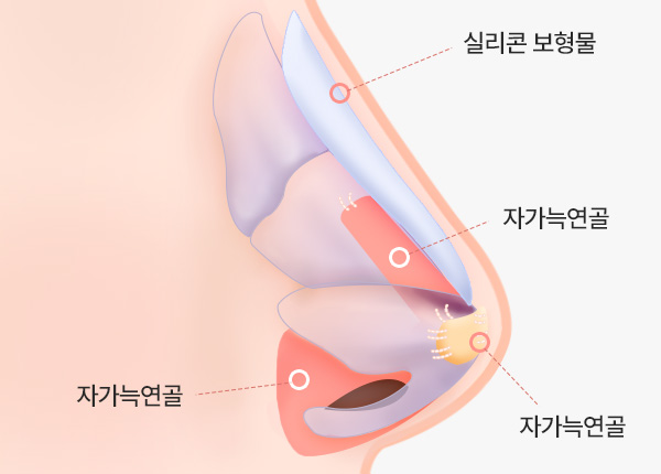 자가늑코성형 수술 방법 5. 연골 삽입 및 고정