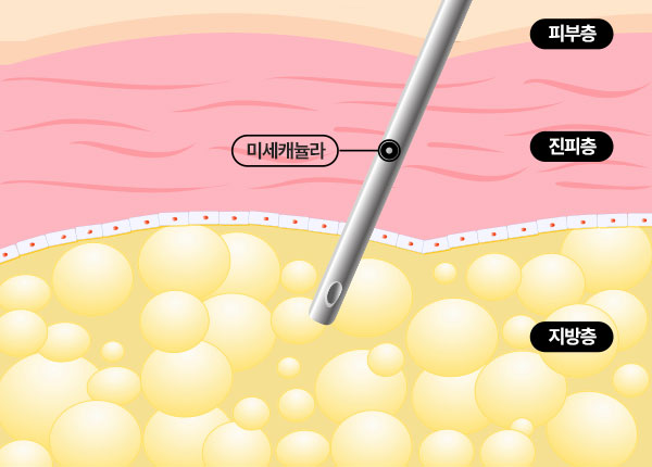조각얼굴 수술 방법 step 03 미세 지방흡입 시술