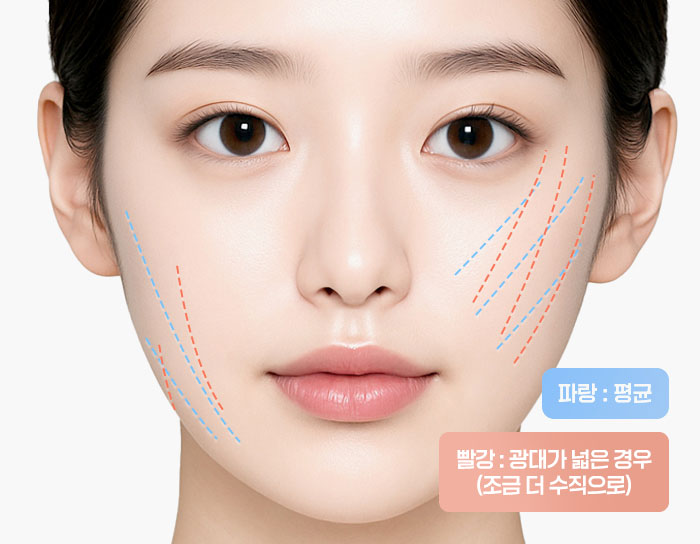 실리프팅 수술 방법 step 01 맞춤 디자인