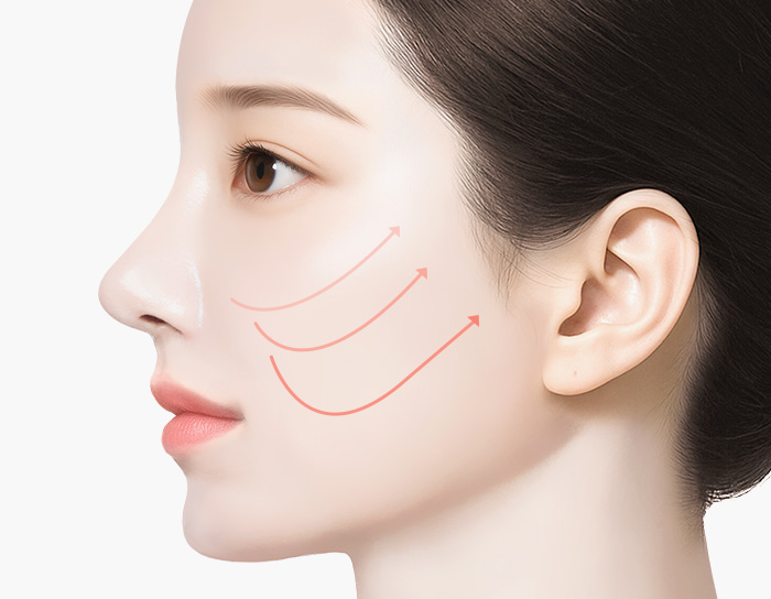 실리프팅 수술 방법 step 02 리프팅실 삽입