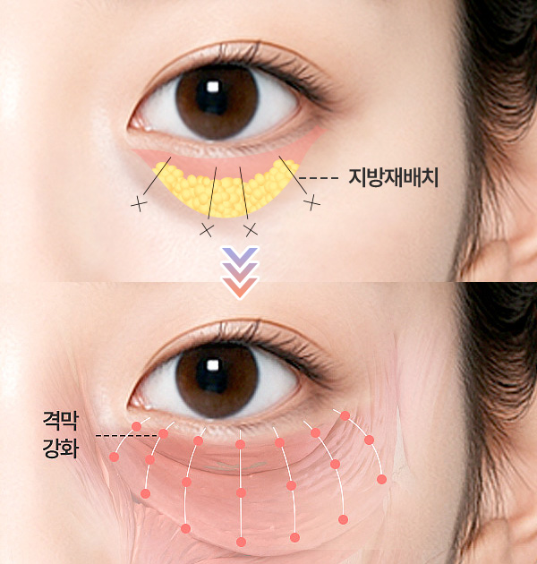 눈밑칙프팅 수술 방법 3. 지방재배치후격막강화