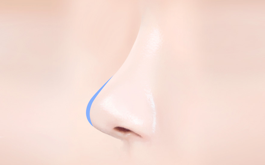 코재수술 유형 1. 코끝 떨어짐