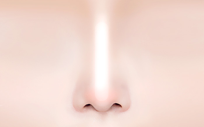 코재수술 유형 8. 보형물이 비치는 경우