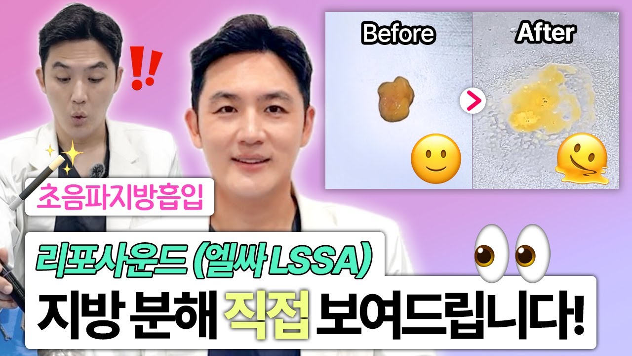 초음파지방흡입 | 리포사운드(엘싸 LSSA) | 지방 분해 과정🔎 직접 보여드릴게요! 👀