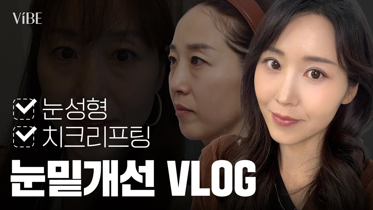 [성형 Vlog] 다크서클, 눈밑주름, 팔자주름 고민 끝! 중안면거상 + 하안검 + 자연유착 쌍꺼풀 3개월 변화✨
