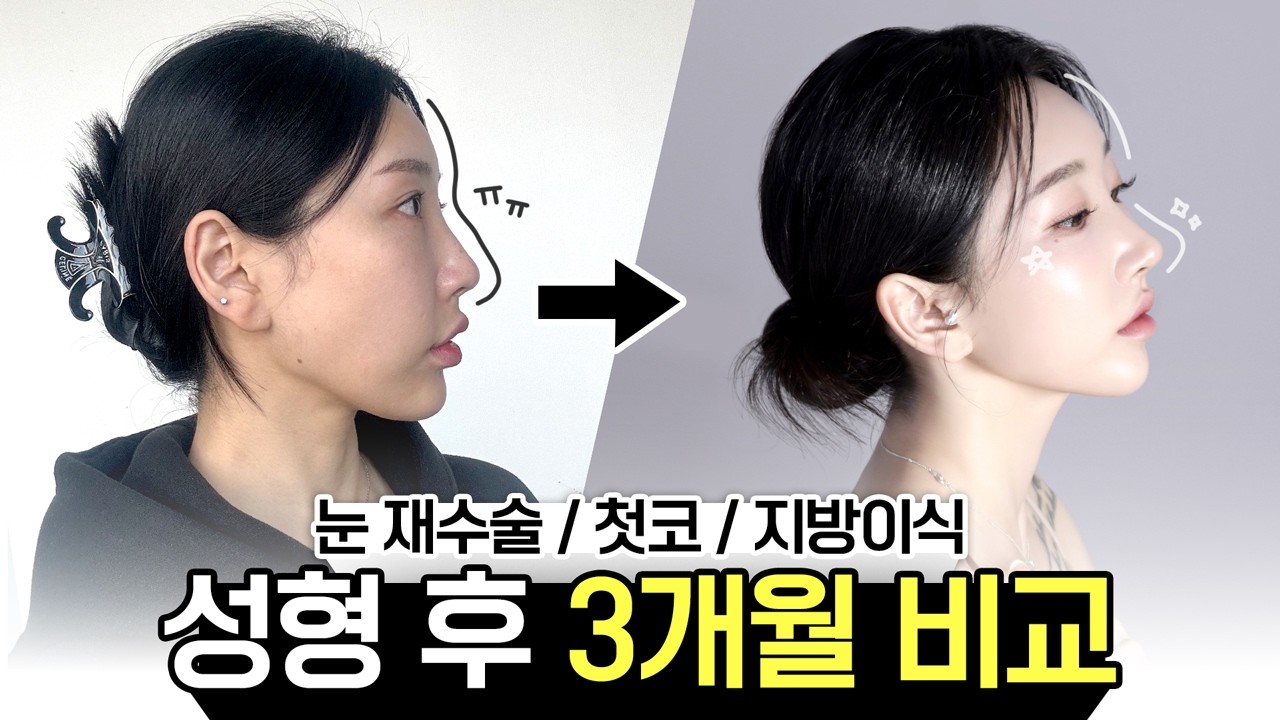 콤플렉스 해결! 변화과정 전부 담은 ⏳3분 성형 브이로그⏳