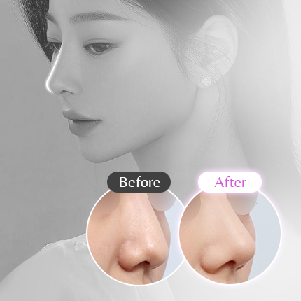 복코, 코끝처짐 고민! 자가늑연골로 완성한 '단연코' 무보형물 코성형 케이스