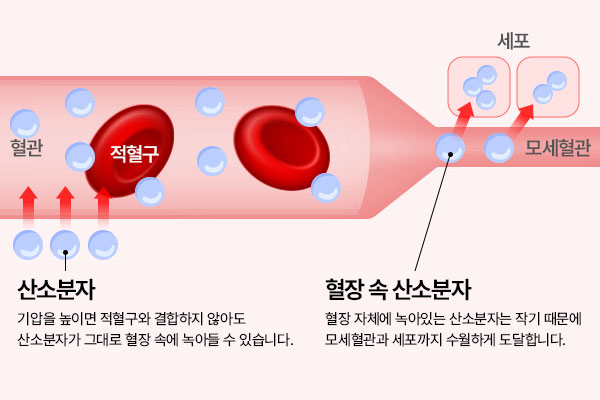 고안산소치료기 내 혈관 2~3기압