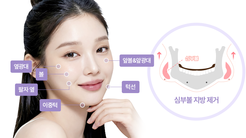 얼굴 지방흡입 - 심부볼