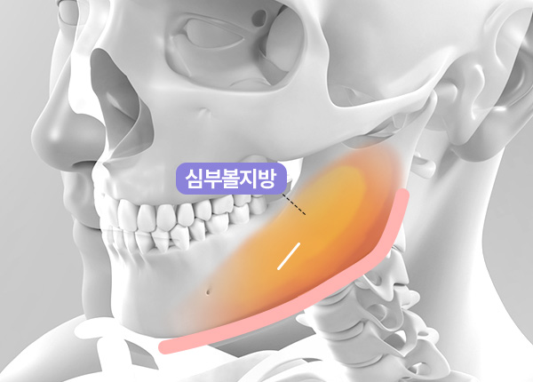 얼굴 지방흡입 수술 방법 step 02 불필요한 지방 선택 제거