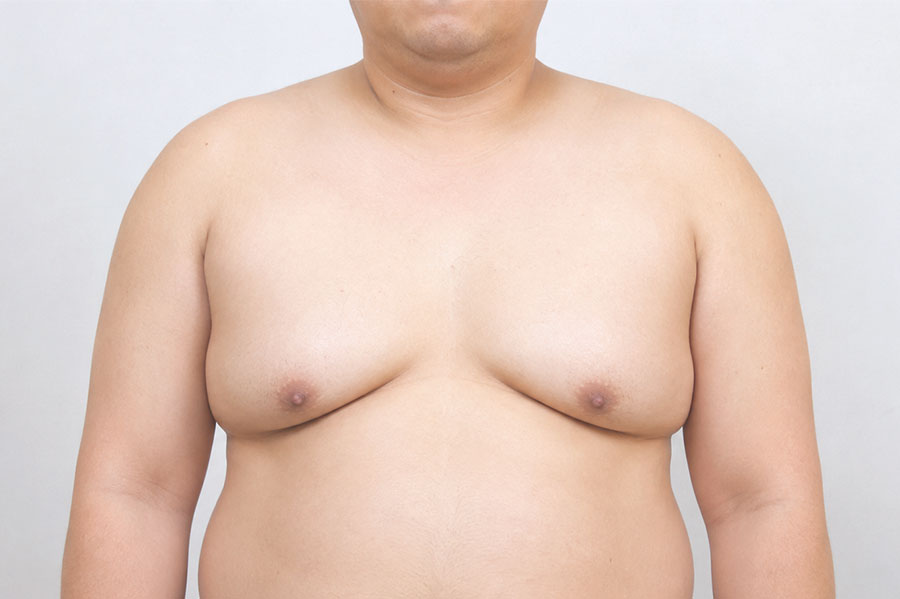 가성 여성형 유방증