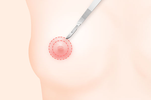 유륜교정 수술법 STEP 2