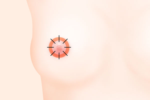 유륜교정 수술법 STEP 3