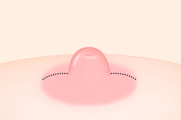 함몰유두 - 유관보존법 (쌈지봉합법) STEP 4