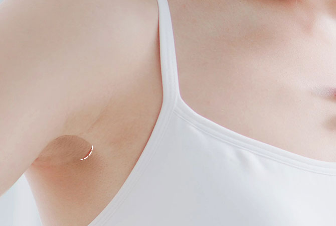 겨드랑이 주름 1cm 최소 절개