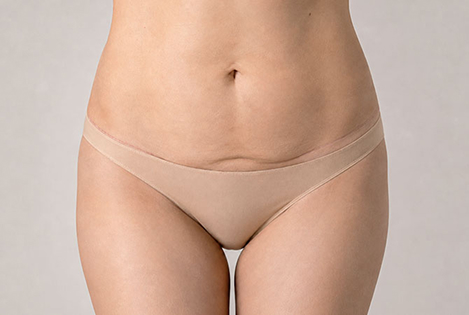 흉터를 고려한 절개 위치