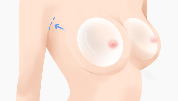 절개 부위에 따른 수술 방법 - 겨드랑이 절개