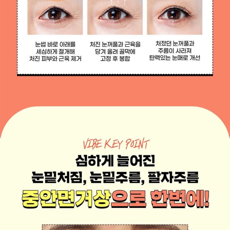 바이브 중년눈성형 이벤트